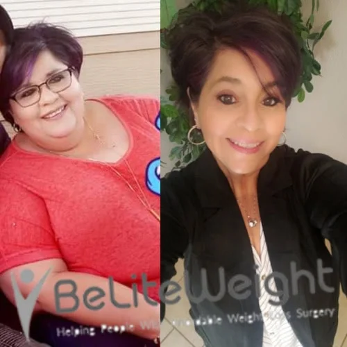 Weight Loss Surgery Before And After